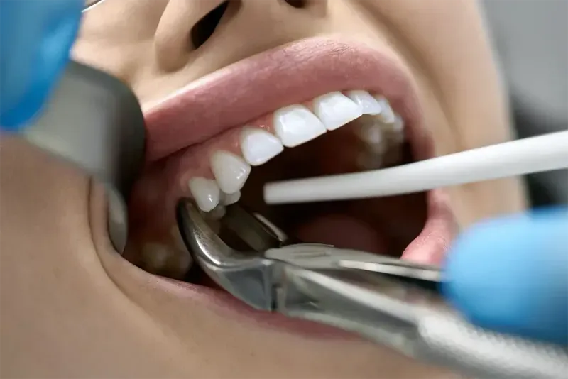 Dental Extraction-p-800